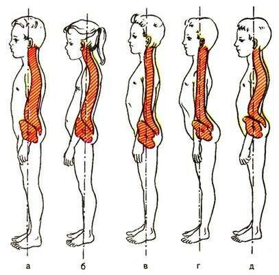 ТИПЫ ОСАНКИ