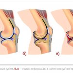 как лечить суставы