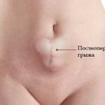 Послеоперационные грыжи